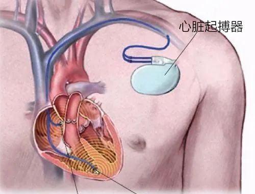 政策解讀 | 進(jìn)口心臟起搏器有哪些監(jiān)管要求锦爵？